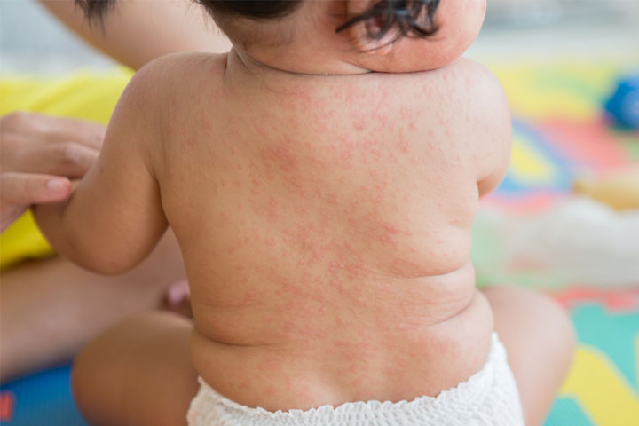 Viral rashes in babies, roseola