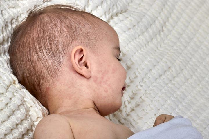 viral-rash-toddler-viral-skin-rash-how-to-recognise-a-viral-skin