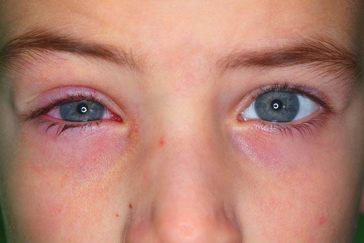 How to identify pink eye (conjunctivitis) in kids