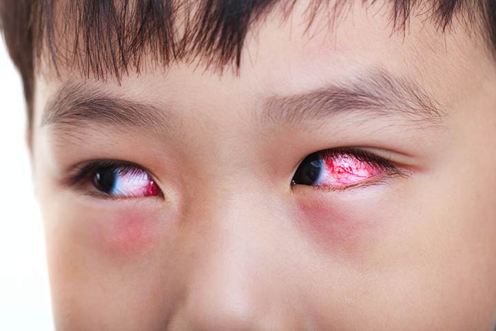 What pink eye (conjunctivitis) in kids looks like