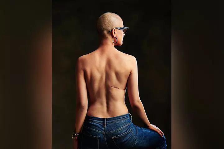 women with breast cancer