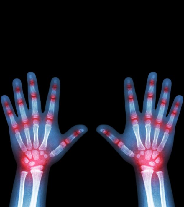 Arthritis In Children: Types, Causes, Symptoms And Treatment