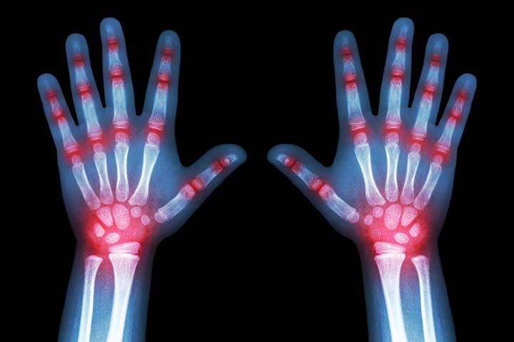 9 Symptoms Of Arthritis In Children, Causes And Treatment