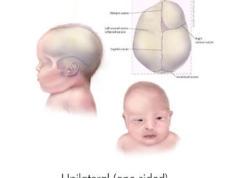 Craniosynostosis In Babies: Symptoms, Diagnosis And Treatment