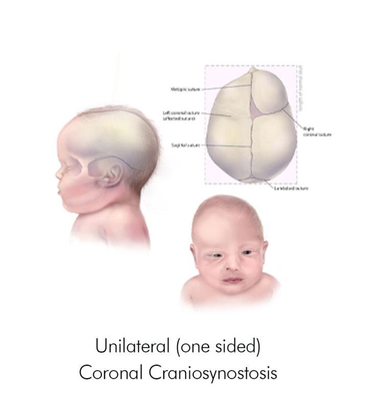 Evaluation Of Staggered Osteotomy In Surgical Therapy Of Trigonocephaly ...