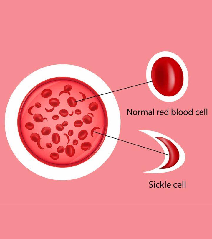 6 signs and symptoms of sickle cell anemia in children