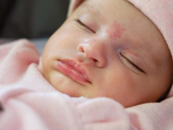 Stork Bite Birthmark: Causes, Signs And Home Treatment