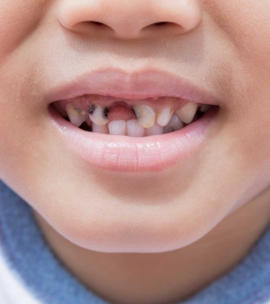 What Causes Tooth Decay In Children Treatment amp Prevention