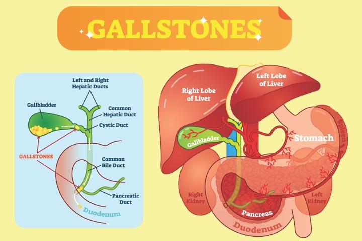 प र गन स म प त त शय क पथर ह न क रण इल ज व जट लत ए Gallbladder Stone In Pregnancy In Hindi