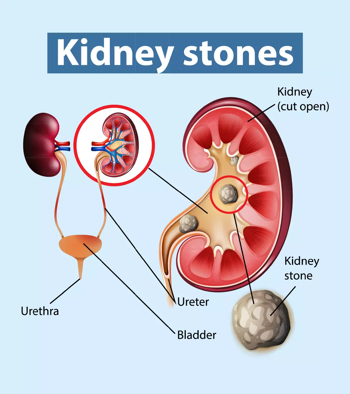 Kidney Stones In Teens Types Causes Symptoms