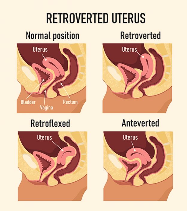 प्रेगनेंसी में रेट्रोवर्टेड यूट्रस: कारण, लक्षण व इलाज | Retroverted Uterus Meaning In Hindi