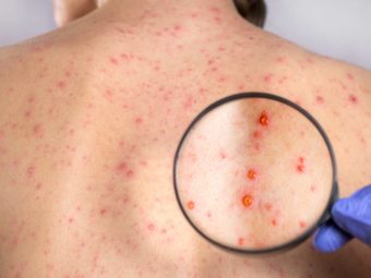 Rubella (German Measles) In Children: Symptoms, Causes, And Treatment