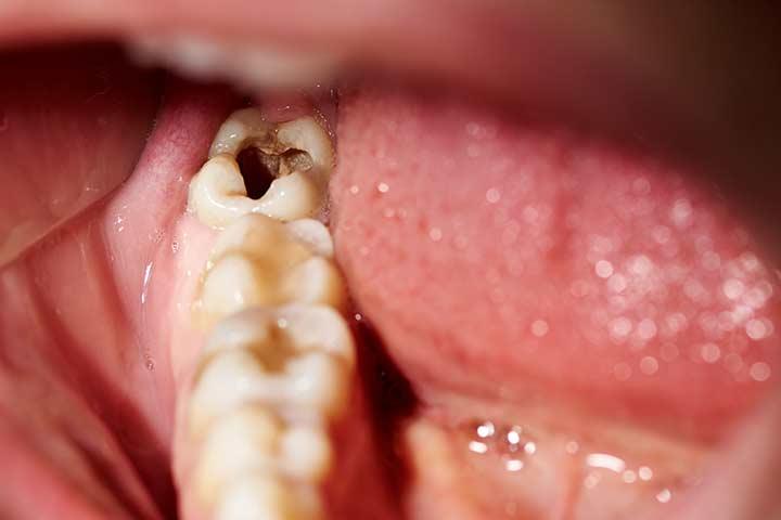 what-causes-tooth-decay-in-children-treatment-prevention