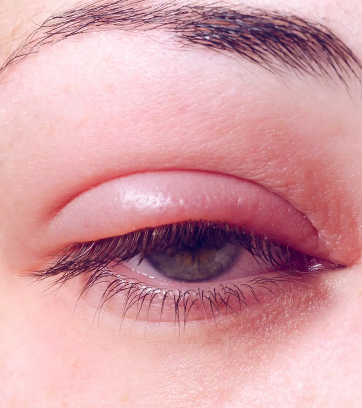What Causes Chalazion In Children And How To Treat