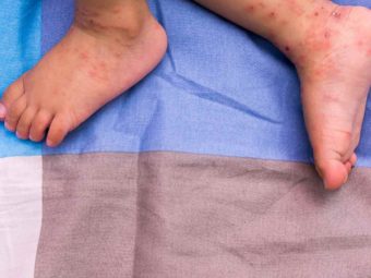 Babies Born With Herpes: Causes, Symptoms And Prevention