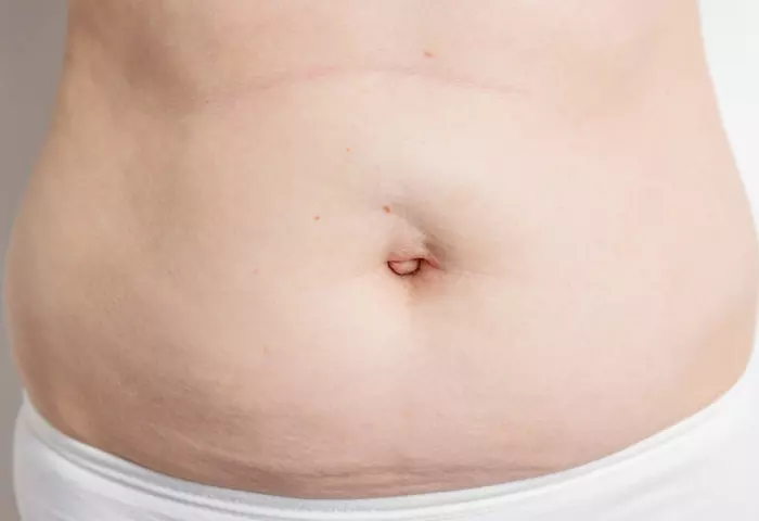 Check For Postpartum Umbilical Hernia