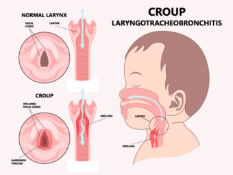 Croup In Children: Symptoms, Causes, Risks And Treatment