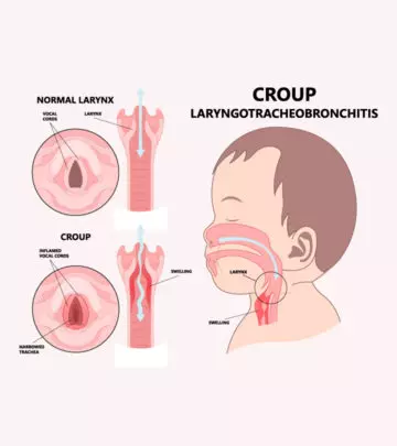 Croup In Children Symptoms, Causes, Risks And Treatment-1