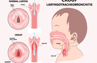 Croup In Children: Symptoms, Causes, Risks And Treatment