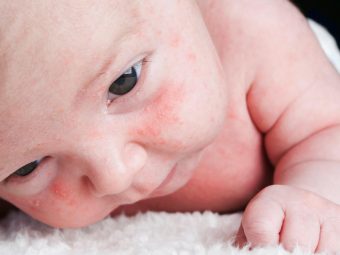 Milia In Newborn Babies: Causes, Types, Symptoms, And Treatment
