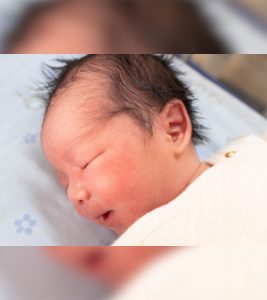 What Causes Caput Succedaneum (Swelling On The Head) In Newborns?