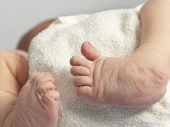 What Is Clubfoot In Babies? Causes, Symptoms And Treatment