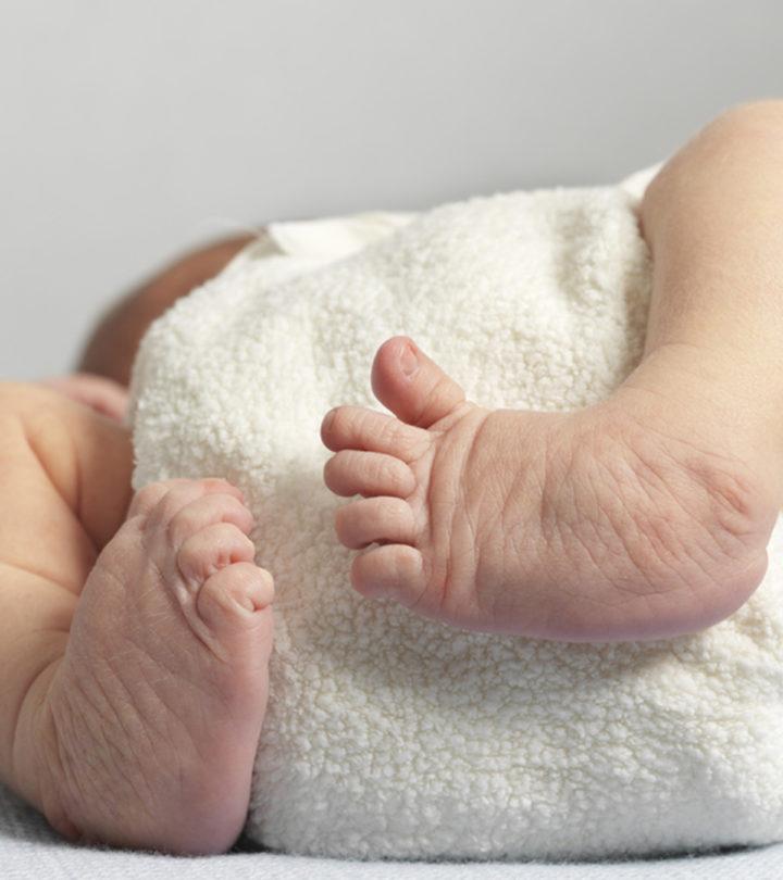 Clubfoot In Baby Causes Diagnosis Treatment Pictures