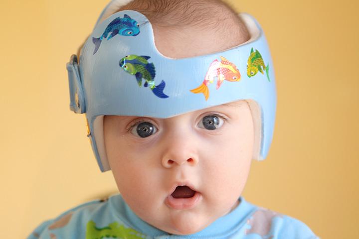 Why Do Babies Wear Helmets?