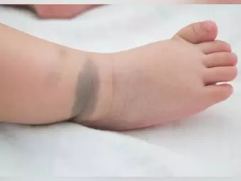 बच्चों में बर्थमार्क (जन्म चिह्न): कारण, प्रकार व प्रभाव | Birthmark In Babies In Hindi