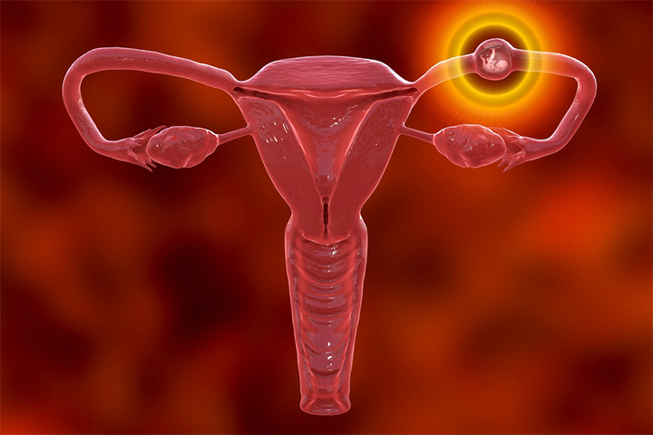 Ectopic pregnancy may be seen if the uterine infection is not treated.