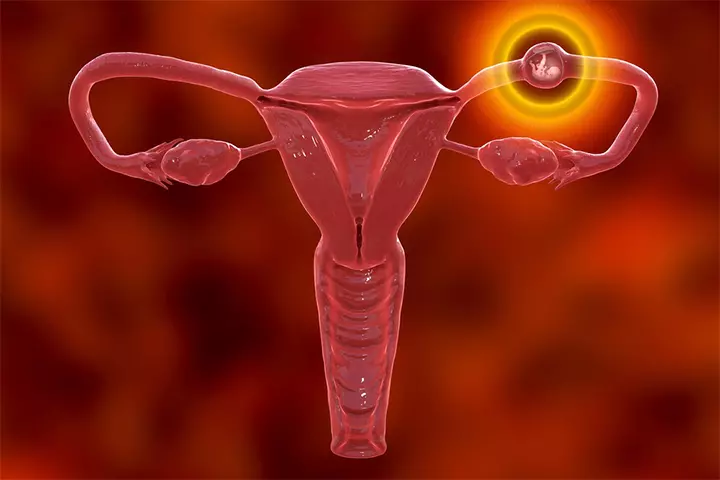 Ectopic pregnancy may be seen if the uterine infection is not treated.