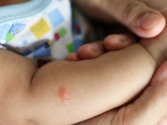Flea Bites On Babies: How They Look, Treatment And Prevention