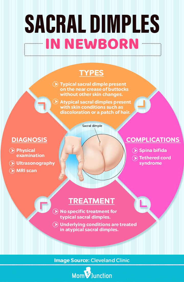 types of sacral dimples in newborn (Infographic)