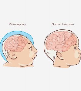 Microcephaly In Babies: Causes, Symptoms And Treatment