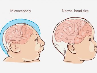 Microcephaly In Babies: Symptoms, Causes And Treatment