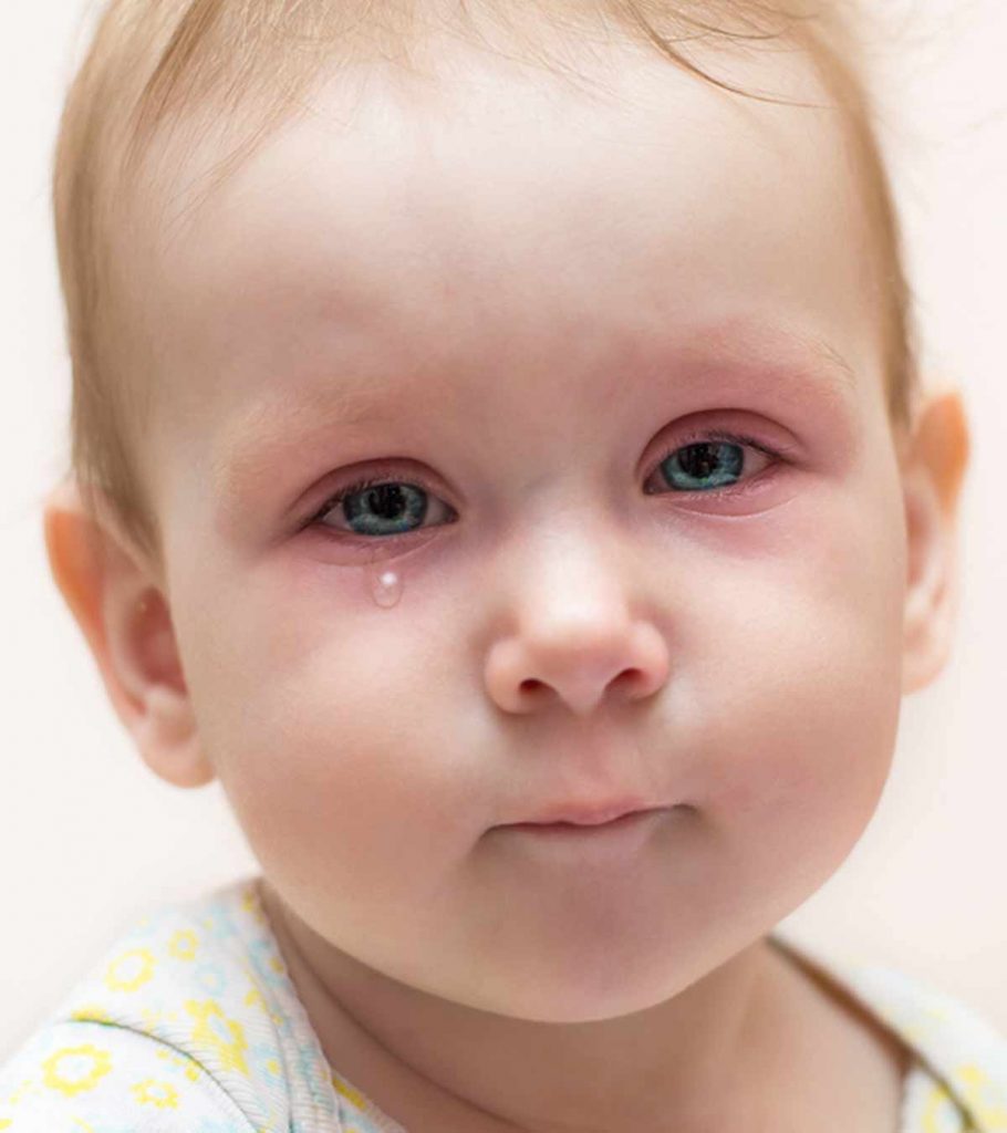 Pink Eye In Toddlers: Causes, Symptoms And Treatment