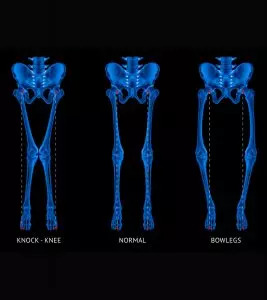 Rickets In Children: Signs, Symptoms, Causes And Treatment