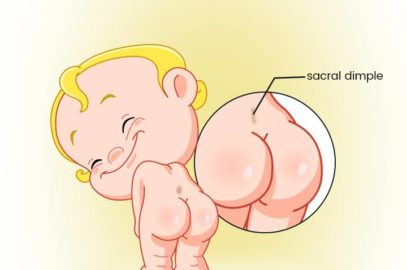 Sacral Dimples in Newborn: Symptoms, Causes And Treatment