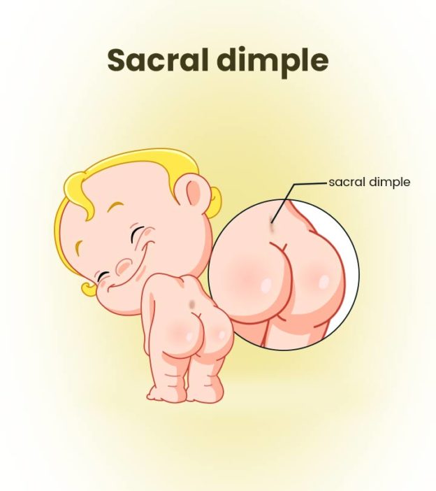 Sacral Dimples in Newborn: Symptoms, Causes And Treatment