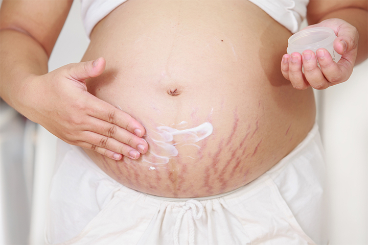 Stretch marks may be seen at 22 weeks pregnant