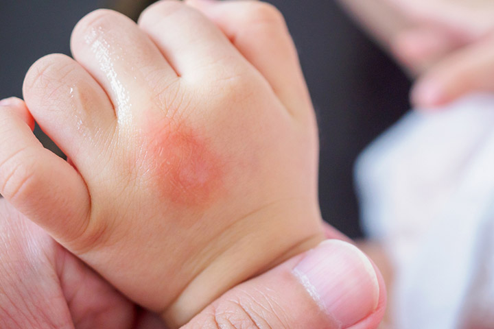 Symptoms of flea bites on babies