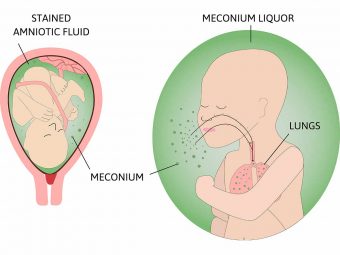 What is Meconium Aspiration Syndrome? Causes And Treatment