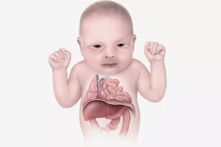 Causes Of CDH In Babies