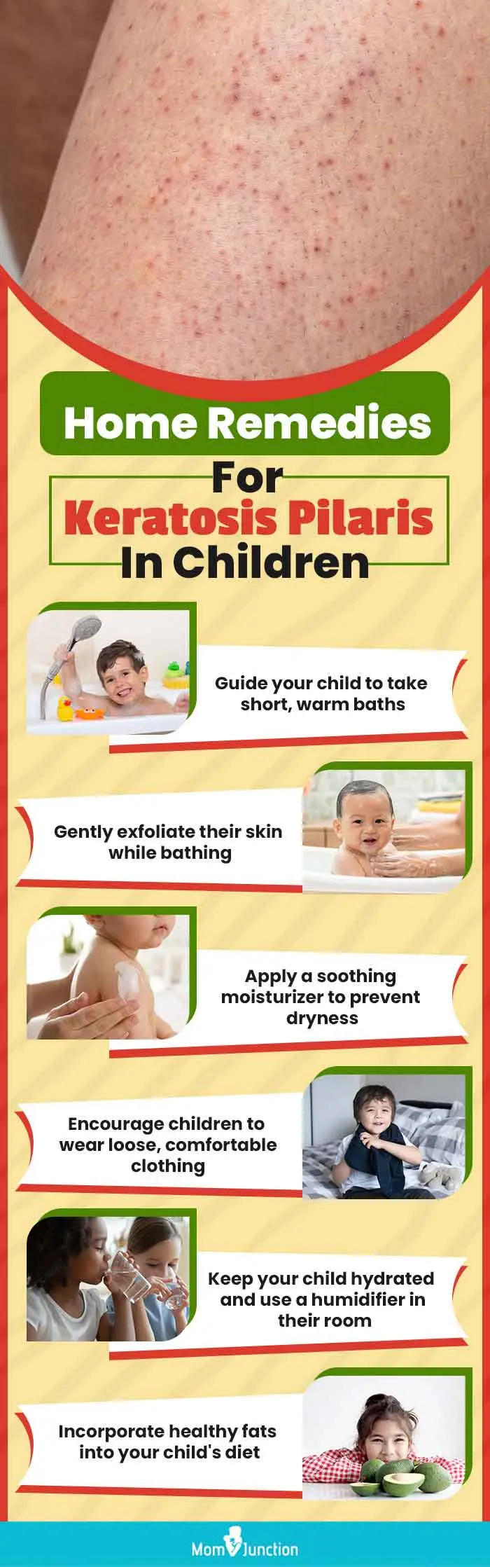 home remedies for keratosis pilaris in children (infographic)