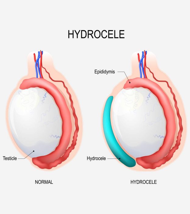 Hydrocele In Babies: Causes, Signs, Diagnosis And Treatment
