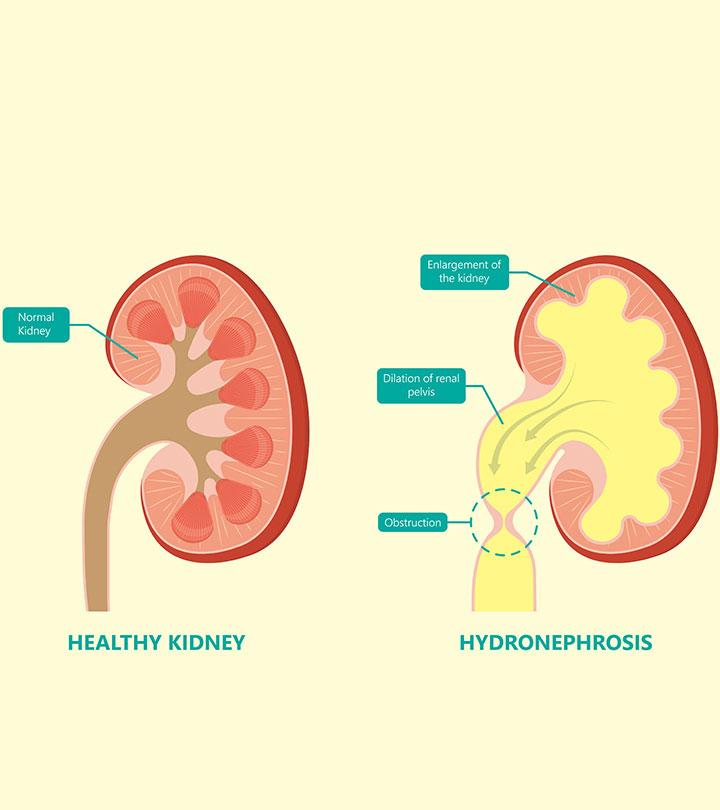 Can Hydronephrosis Cause Kidney Rupture