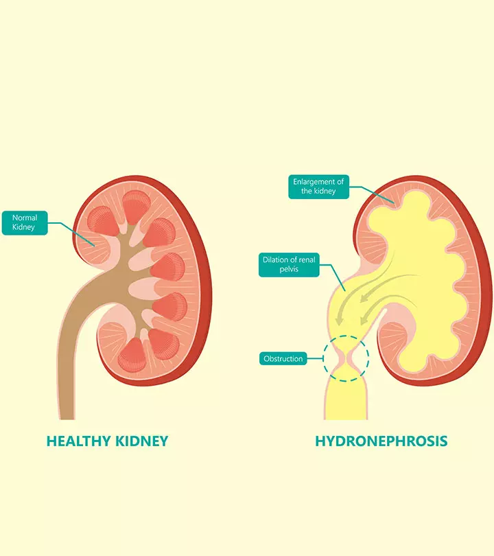 Hydronephrosis In Babies Symptoms, Causes & Treatment