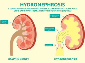 Hydronephrosis In Babies: Symptoms, Causes & Treatment