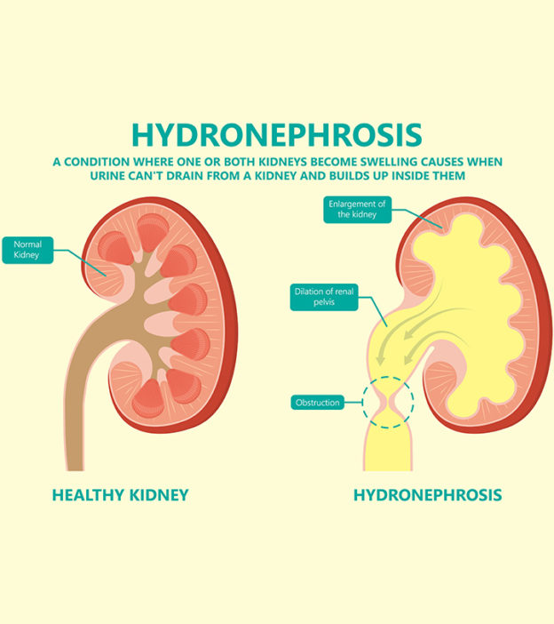 Hydronephrosis In Babies: Symptoms, Causes & Treatment