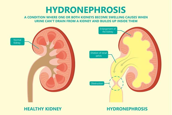 hydronephrosis-in-babies-causes-symptoms-and-treatment